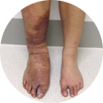 Klippel-Trenaunay Syndrome (KTS)